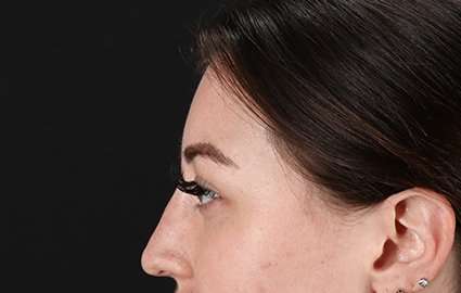 Brow Lift Before & After Patient #4766
