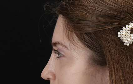Brow Lift Before & After Patient #4777