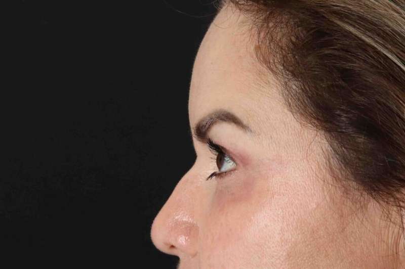 Brow Lift Before & After Patient #4843