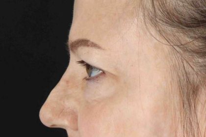 Brow Lift Before & After Patient #4854