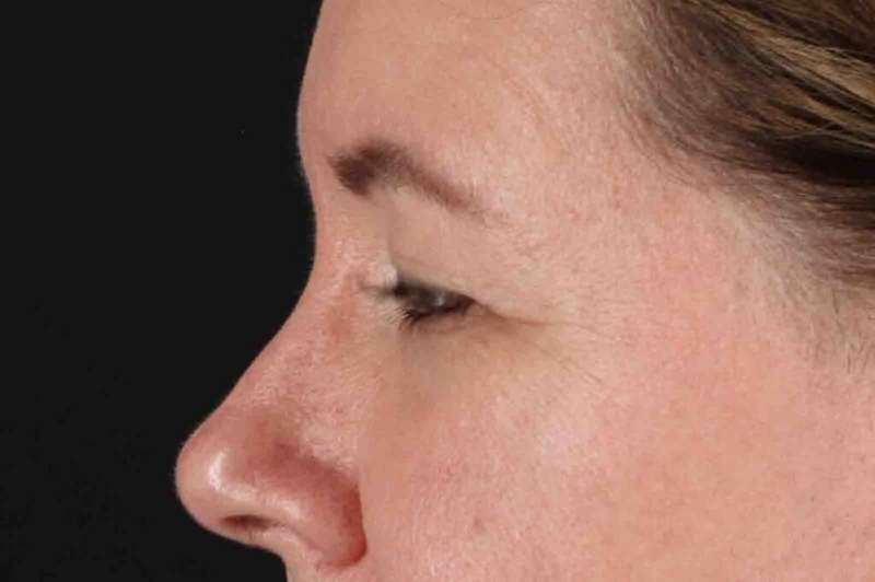 Brow Lift Before & After Patient #4865