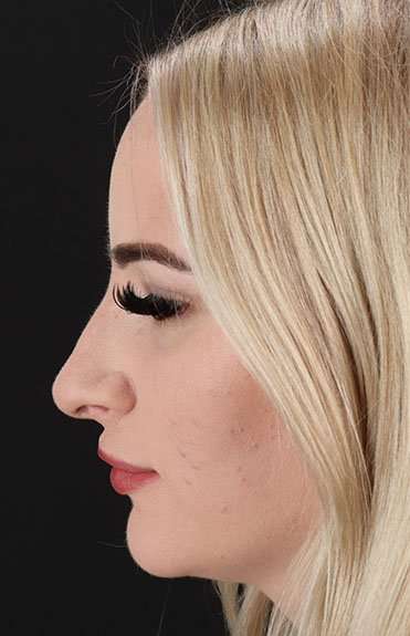 Brow Lift Before & After Patient #4876