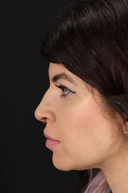 Brow Lift Before & After Patient #4912