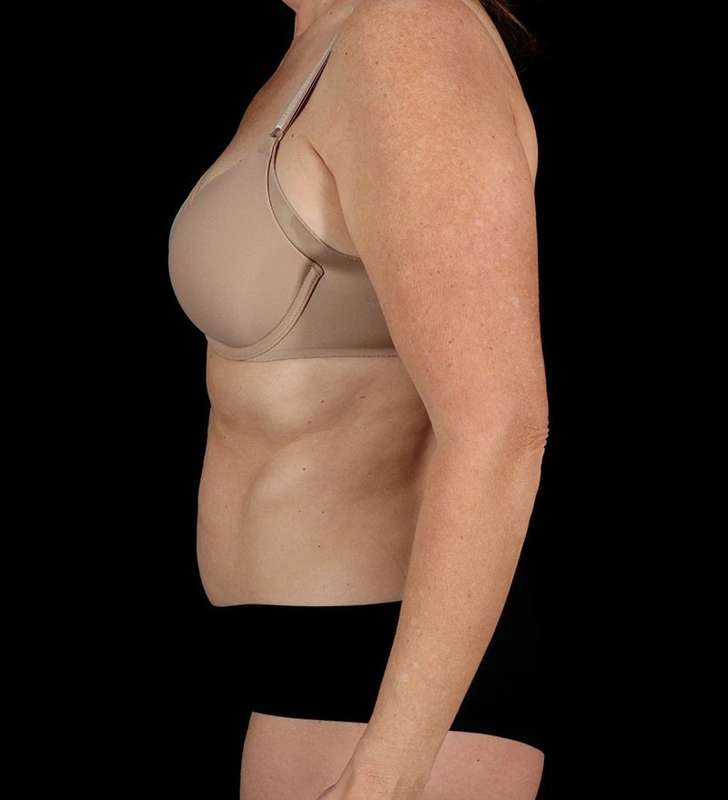 Abdominoplasty (Tummy Tuck) Before & After Patient #1029
