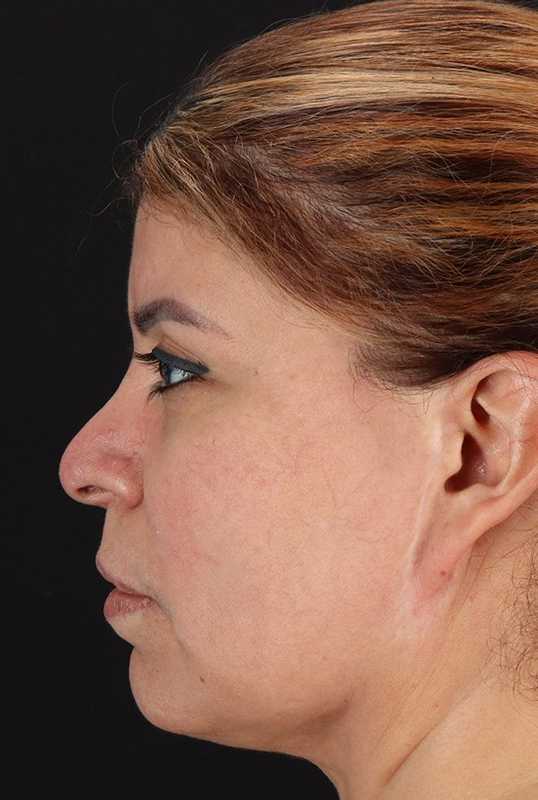 Earlobe Repair Before & After Patient #5064