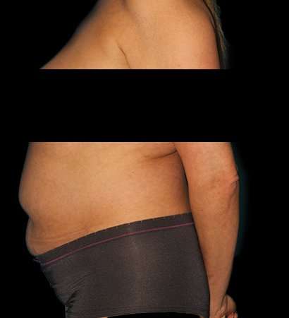 Abdominoplasty (Tummy Tuck) Before & After Patient #590