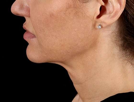 Facelift Before & After Patient #5185
