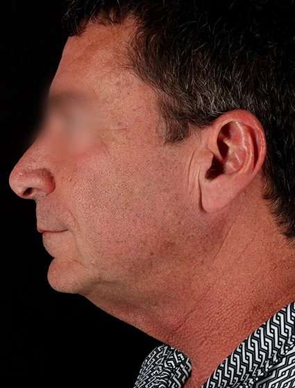 Facelift Before & After Patient #5207