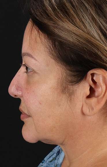 Facelift Before & After Patient #5218