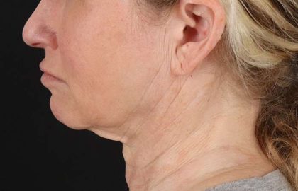 Facelift Before & After Patient #5240