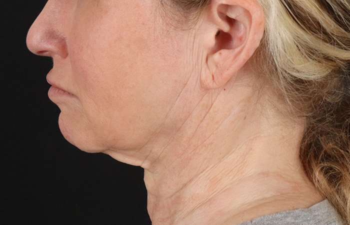Facelift Before & After Patient #5240