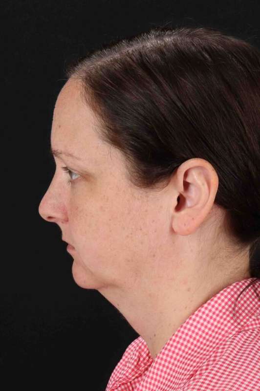 Facelift Before & After Patient #5273