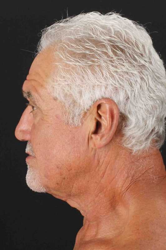 Facelift Before & After Patient #5306