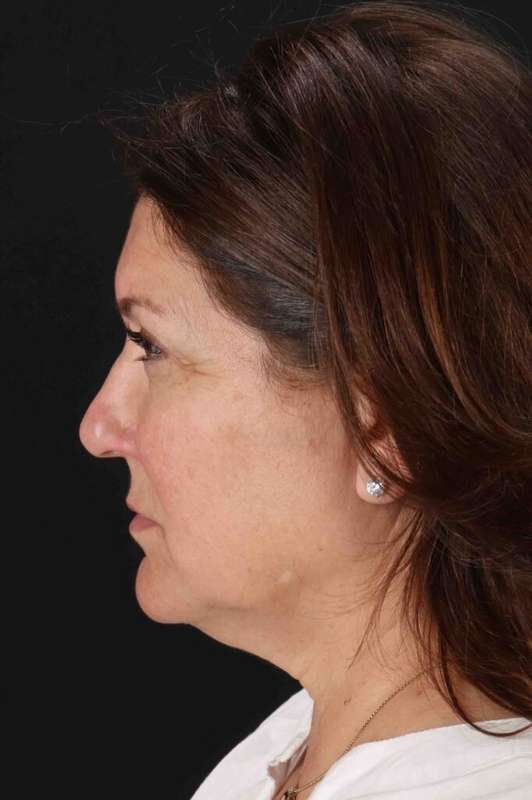 Facelift Before & After Patient #5326