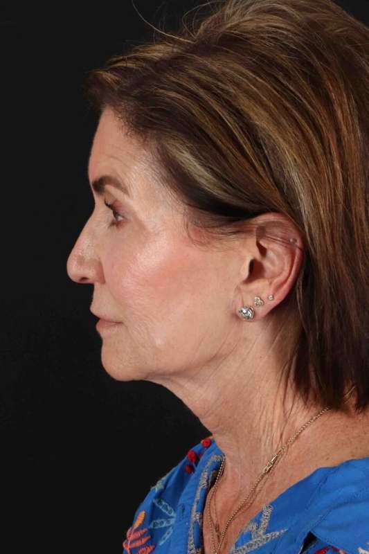 Facelift Before & After Patient #5337