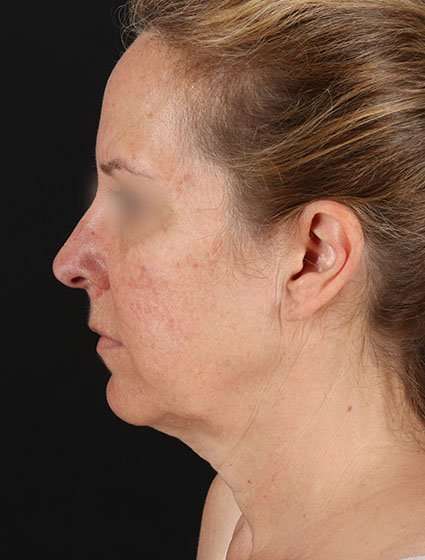 Facelift Before & After Patient #5359