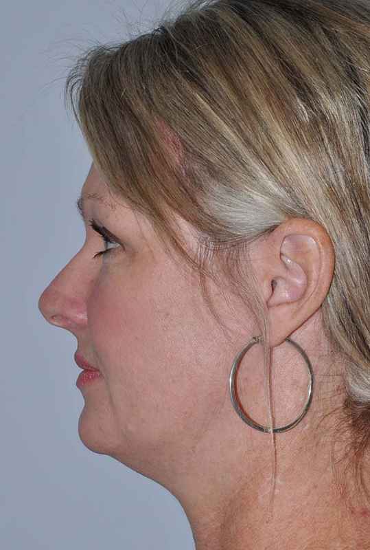 Facelift Before & After Patient #5385