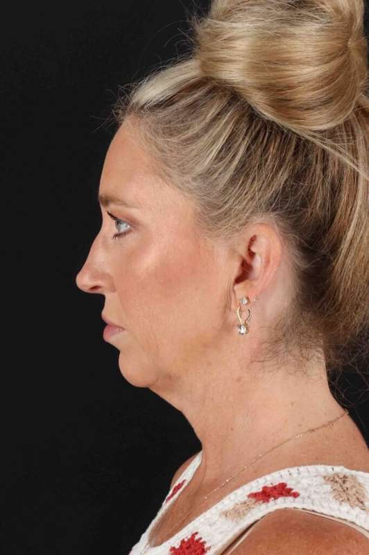 Facelift Before & After Patient #5488