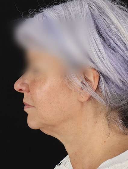 Facelift Before & After Patient #5499