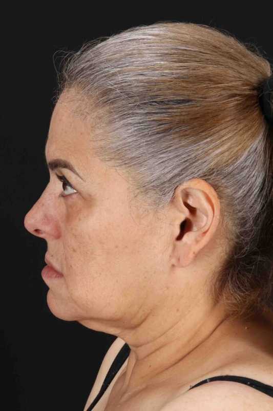 Facelift Before & After Patient #5510