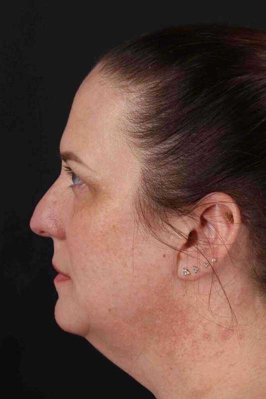 Facelift Before & After Patient #5521