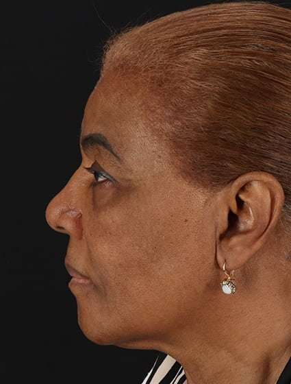 Chemical Peels Before & After Patient #5554