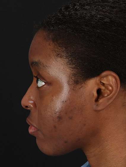 Chemical Peels Before & After Patient #5568