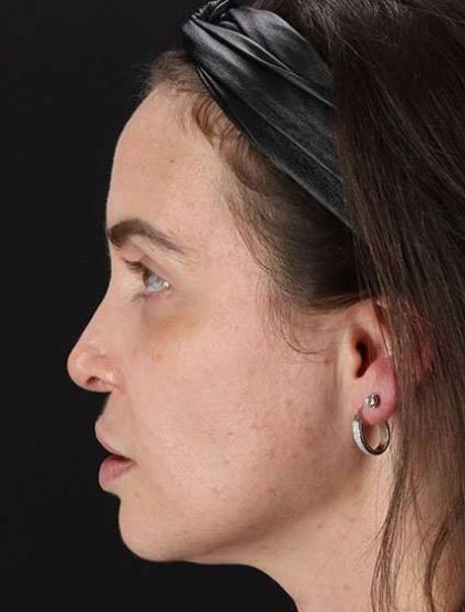 Chemical Peels Before & After Patient #5579