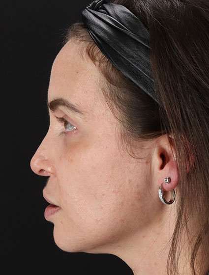 Chemical Peels Before & After Patient #5579