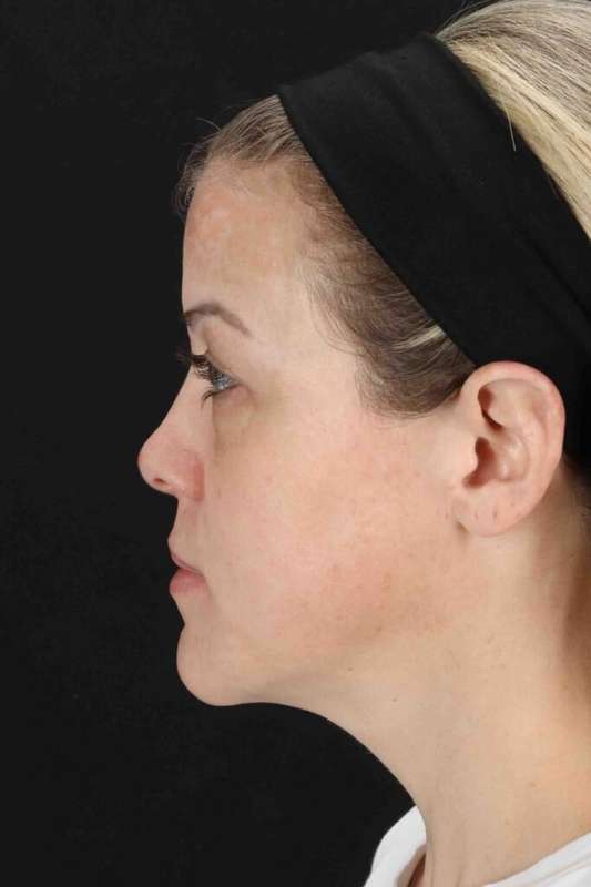 Chemical Peels Before & After Patient #5601