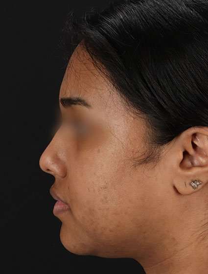 Chemical Peels Before & After Patient #5621
