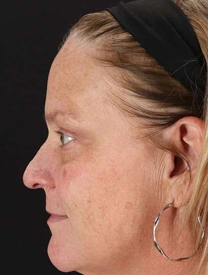 Chemical Peels Before & After Patient #5632
