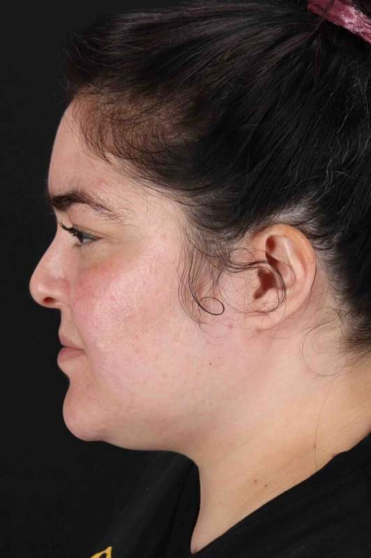 Neck Liposuction Before & After Patient #5643