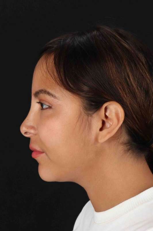 Neck Liposuction Before & After Patient #5654