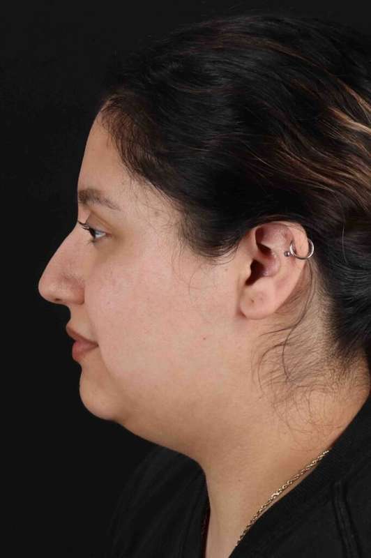 Neck Liposuction Before & After Patient #5665