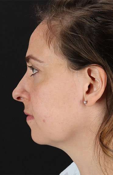 Neck Liposuction Before & After Patient #5687