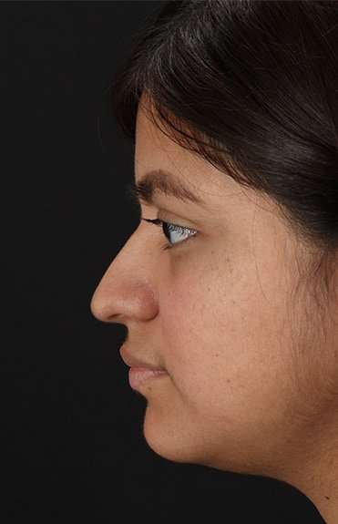 Neck Liposuction Before & After Patient #5709
