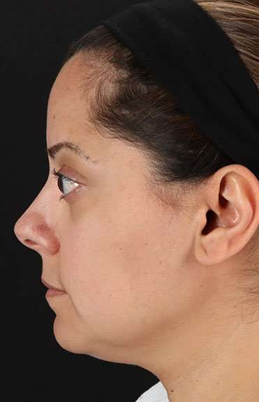 Neck Liposuction Before & After Patient #5720
