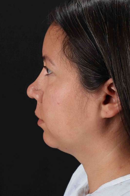 Neck Liposuction Before & After Patient #5731