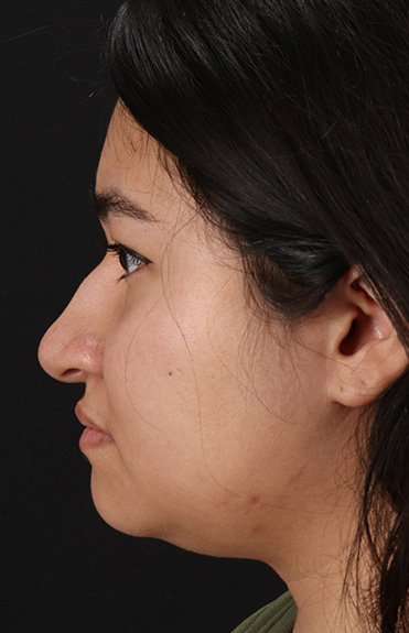 Neck Liposuction Before & After Patient #5742