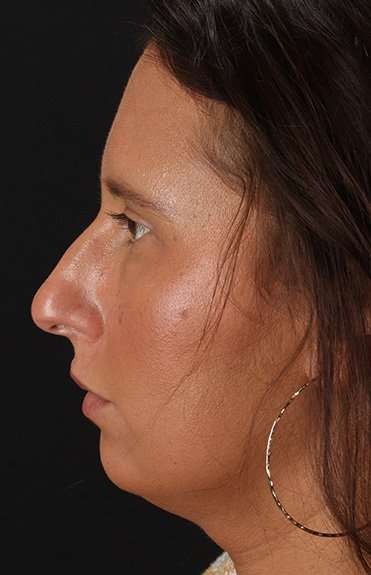 Neck Liposuction Before & After Patient #5753