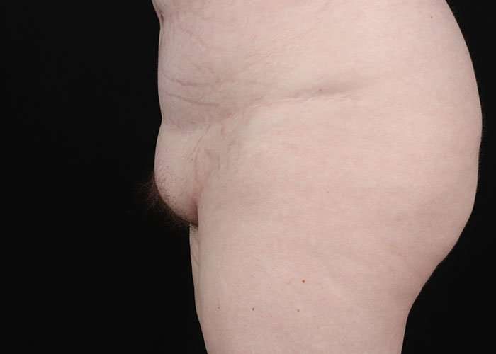 Monsplasty Before & After Patient #1117