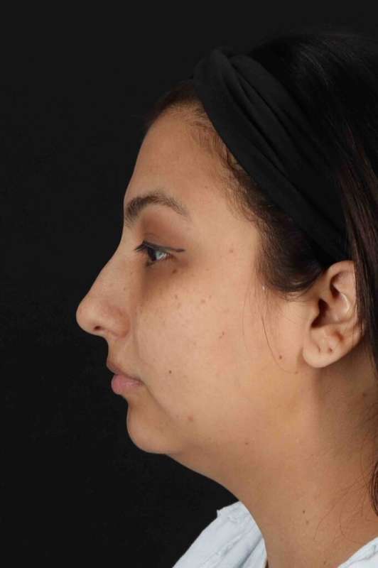 Rhinoplasty Before & After Patient #5826
