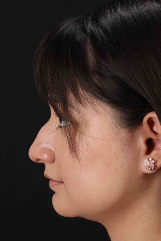 Rhinoplasty Before & After Patient #5837