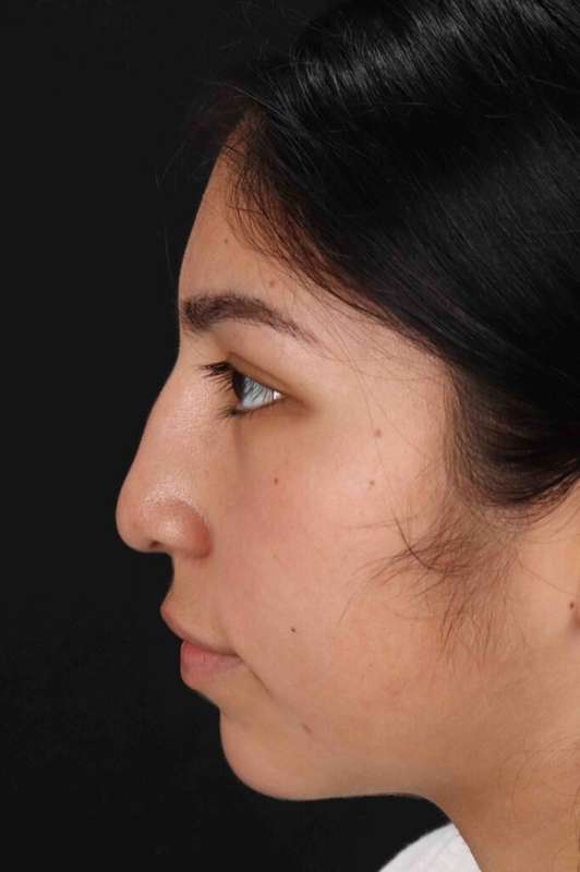 Rhinoplasty Before & After Patient #5848