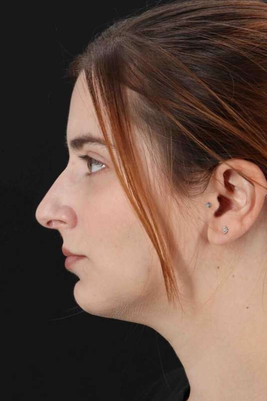 Rhinoplasty Before & After Patient #5859