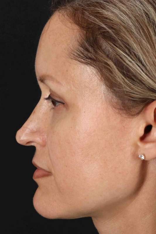 Rhinoplasty Before & After Patient #5870