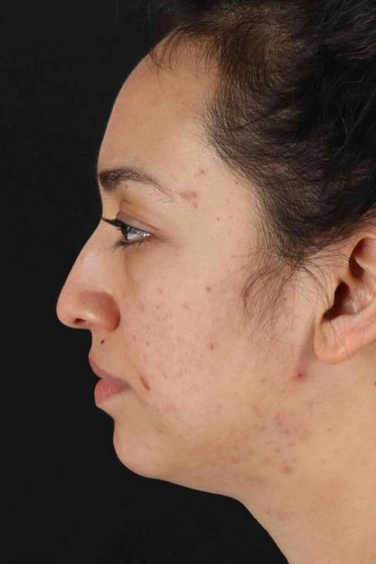 Rhinoplasty Before & After Patient #5881