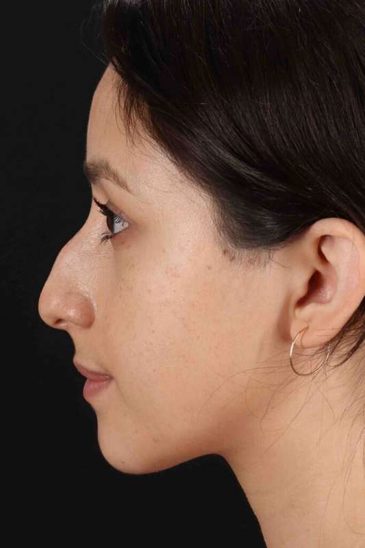 Rhinoplasty Before & After Patient #5892
