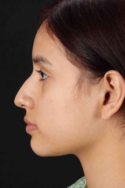 Rhinoplasty Before & After Patient #5903